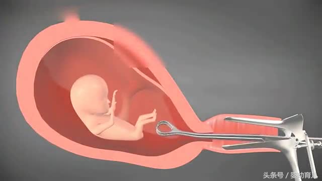 人工流产的胎儿会变成什么样,人工流产的胎儿在肚子里什么样