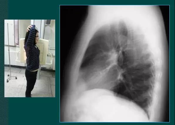 读完该文，让你学会如何看胸片