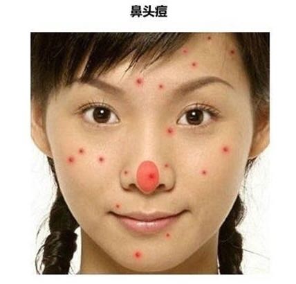 看图识别痘痘,看懂各种痘痘类型和应对方法