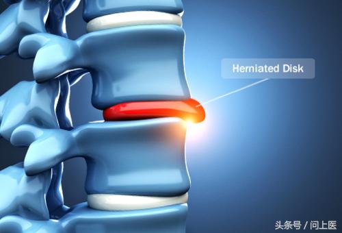 颈部疾病怎么护理,颈部疾病病人的护理