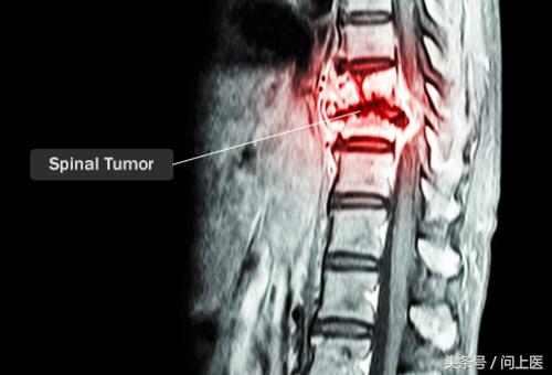 颈部疾病怎么护理,颈部疾病病人的护理