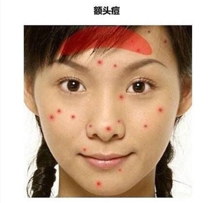 看图识别痘痘,看懂各种痘痘类型和应对方法