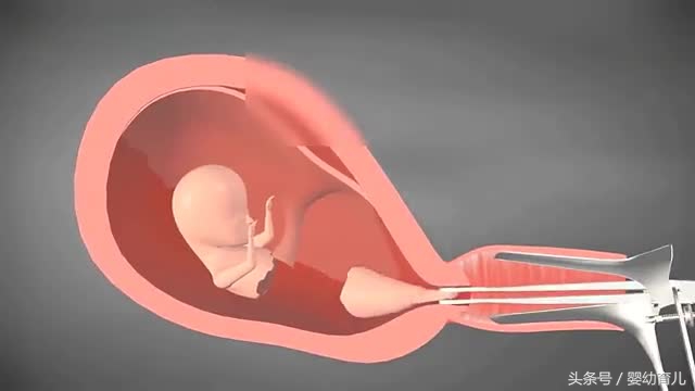 人工流产的胎儿会变成什么样,人工流产的胎儿在肚子里什么样