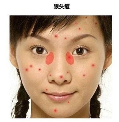 看图识别痘痘,看懂各种痘痘类型和应对方法