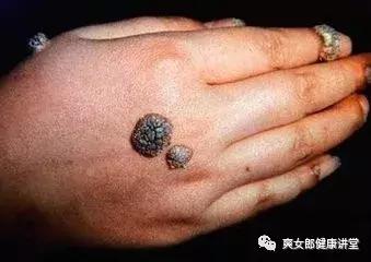得了尖锐性湿疣如何应对,得了尖锐性湿疣怎么根治