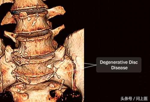 颈部疾病怎么护理,颈部疾病病人的护理