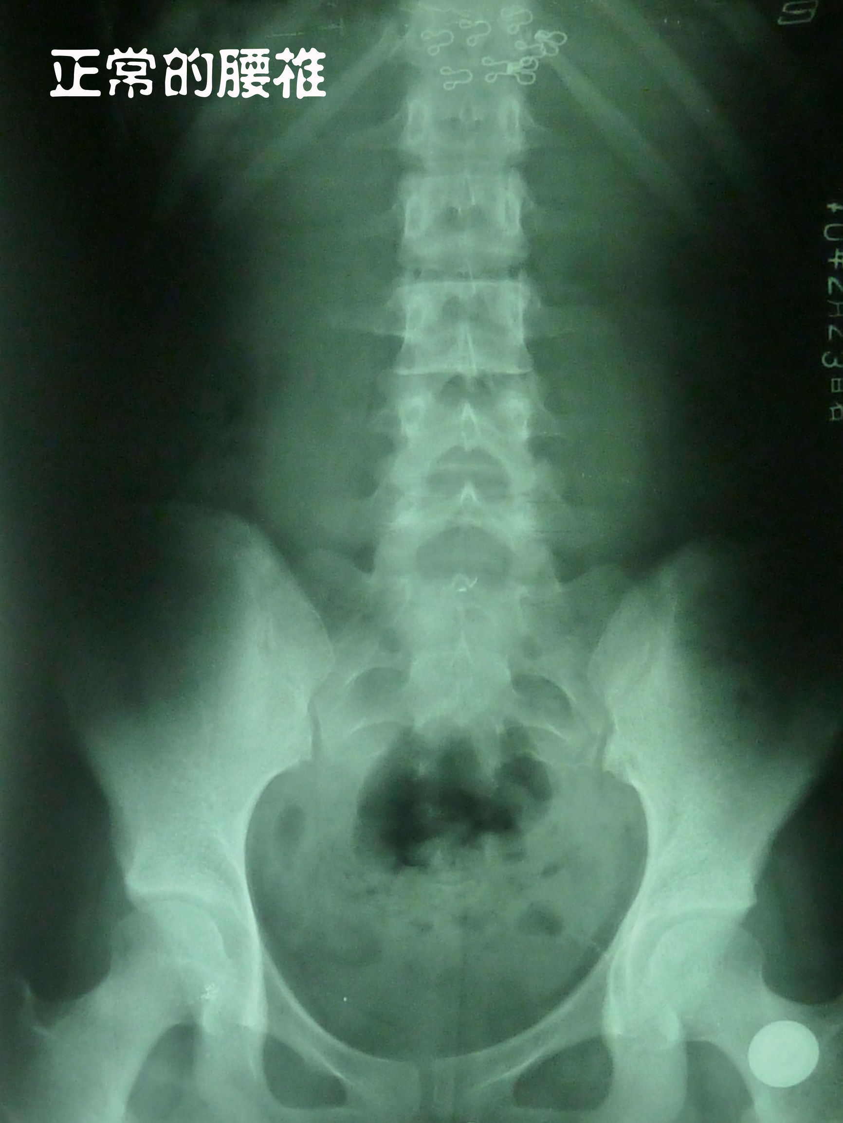 脊椎微讲堂｜腰椎间盘突出：究竟能否治愈？如何治？