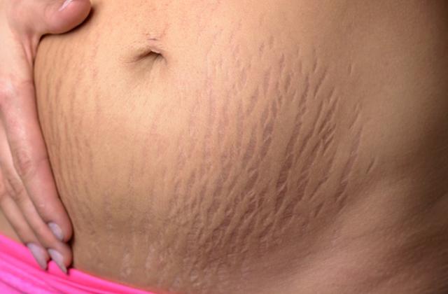 怀孕后如何消除妊娠纹：12个有效方法任你选