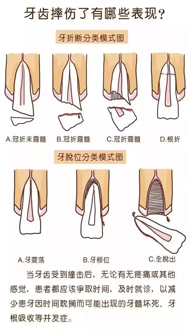 孩子摔断门牙治疗怎么走保险,孩子摔断了牙