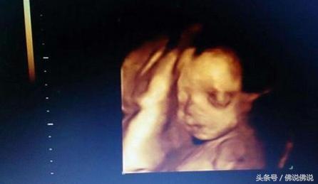 做四维彩超有什么关注事项,做四维彩超的关注事项是什么