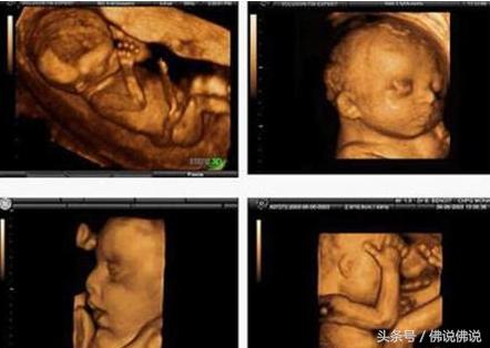 做四维彩超有什么关注事项,做四维彩超的关注事项是什么