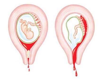 孕期一大杀手——先兆流产发生先兆流产该怎么办？