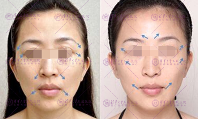 超声刀和热玛吉区别适合人群,热玛吉和超声刀该怎么选