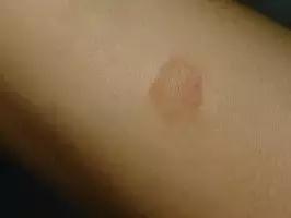 传染猫癣的人能根治吗,传染了猫癣可以抹红霉素吗