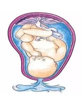 孕妇胎膜早破会影响胎儿发育吗,胎膜早破怎么预防