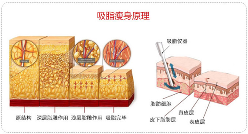 最先进的吸脂减肥,神乎其神减肥成功案例