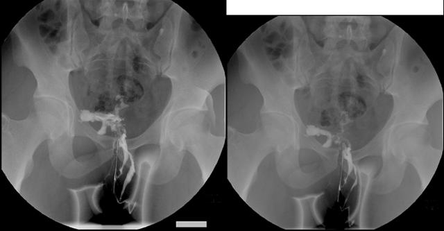 肛瘘中医诊断及鉴别,肛瘘如何诊断