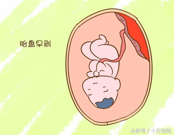怀孕35周发现死胎怎么办,怀孕31周胎死腹中会有什么症状