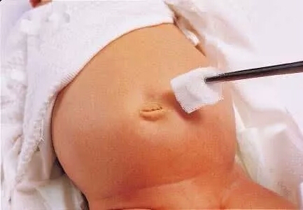 新生宝宝肚脐出血结痂要清洗吗,脐带脱落脐部有出血