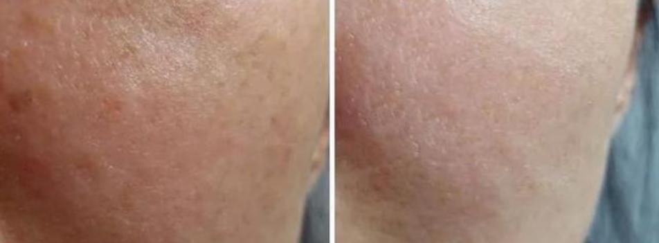 prp自体血清修复疗法,prp自体血清注射面部恢复期