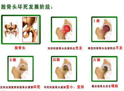 上海治疗关节置换术最好的医院,修复股骨头的最佳方法
