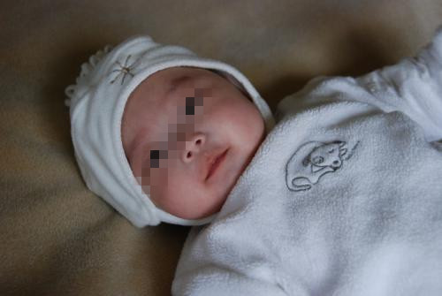 神经纤维瘤做哪些检查能确定,10个月的宝宝确诊神经纤维瘤