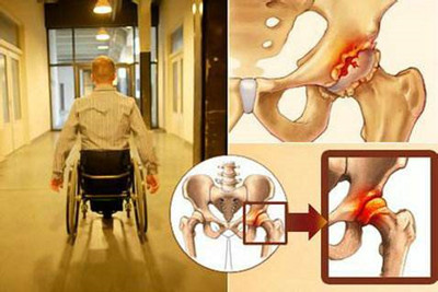 上海治疗关节置换术最好的医院,修复股骨头的最佳方法