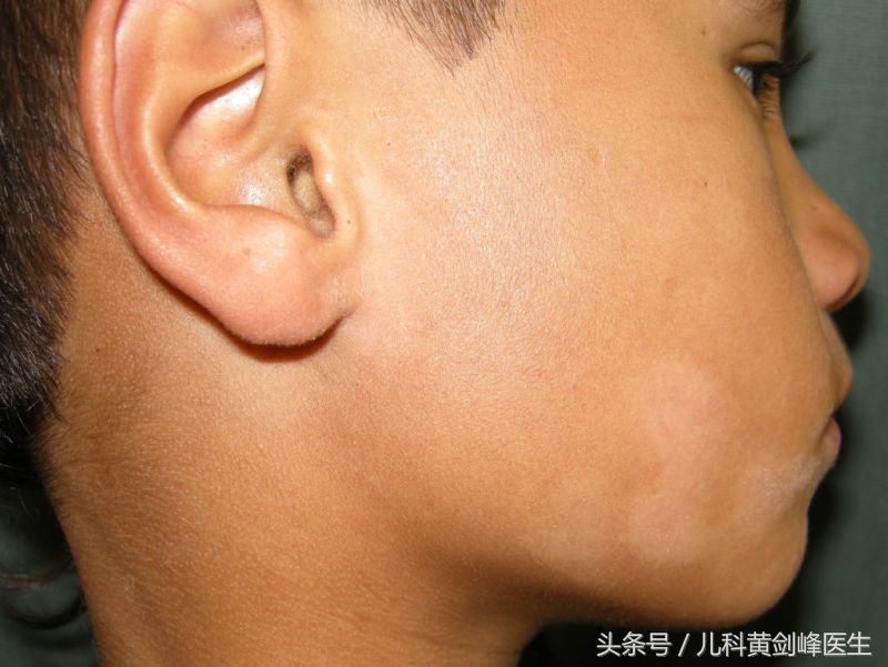 宝宝脸上白点外面一圈黑,宝宝脸上有白点是有虫子吗