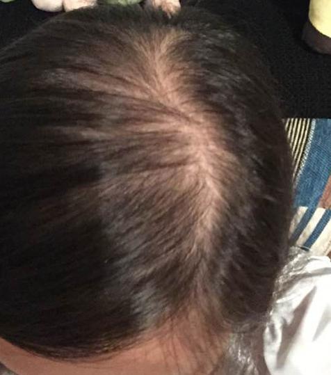 脂溢性脱发遗传性脱发植发有用吗,植发是不是治疗脱发最好的方法