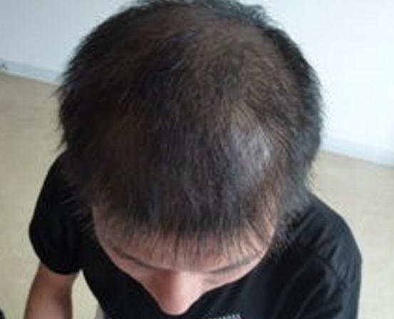 脂溢性脱发遗传性脱发植发有用吗,植发是不是治疗脱发最好的方法