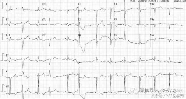 冠脉介入术的介绍,复杂冠脉介入病例