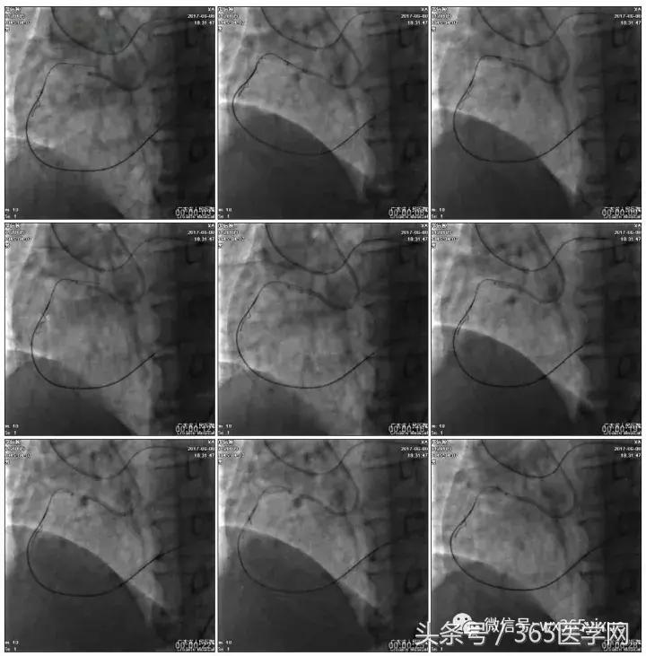 冠脉介入术的介绍,复杂冠脉介入病例