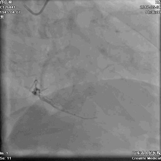 冠脉介入术的介绍,复杂冠脉介入病例