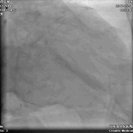 冠脉介入术的介绍,复杂冠脉介入病例