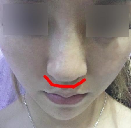 线雕的十大骗局,揭秘线雕埋线你不知道的内幕