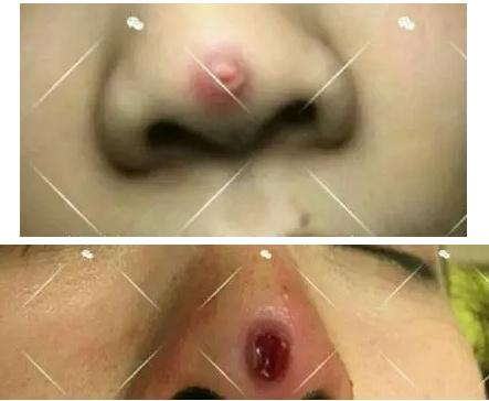 线雕的十大骗局,揭秘线雕埋线你不知道的内幕