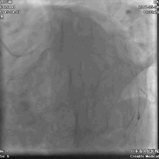 冠脉介入术的介绍,复杂冠脉介入病例