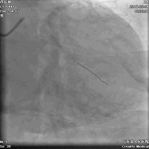 冠脉介入术的介绍,复杂冠脉介入病例