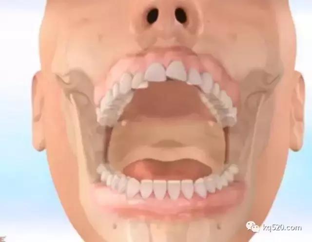 牙套上的丑钢丝,牙套上钢丝有一点锈