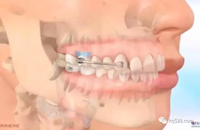 牙套上的丑钢丝,牙套上钢丝有一点锈