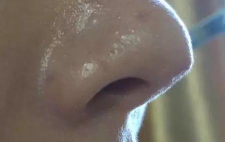 线雕的十大骗局,揭秘线雕埋线你不知道的内幕