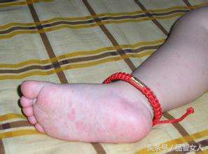 一岁宝宝突然高烧是幼儿急疹吗,婴儿急疹高烧超过40