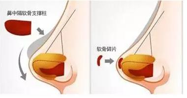 线雕的十大骗局,揭秘线雕埋线你不知道的内幕