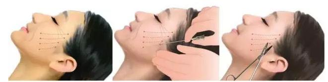 线雕的十大骗局,揭秘线雕埋线你不知道的内幕