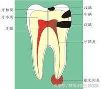 蛀牙坏了一半要根管治疗吗,蛀牙整颗烂到只剩牙根要拔吗