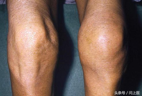 高中生膝盖疼痛的原因和解决方法,爬楼梯膝盖疼痛的原因和解决方法