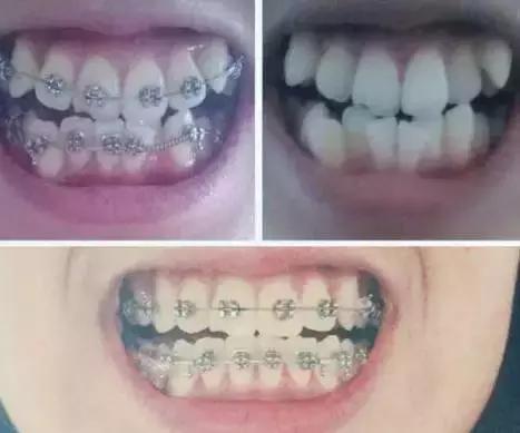 牙齿矫正的风险和后遗症,14岁孩子牙齿矫正拔牙有风险吗