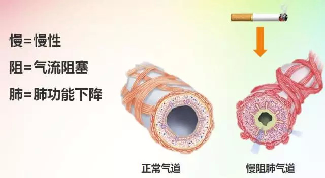 慢阻肺咳嗽怎么治,慢阻肺有效咳嗽咳痰的方法