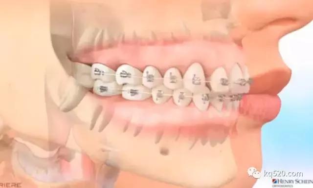 牙套上的丑钢丝,牙套上钢丝有一点锈