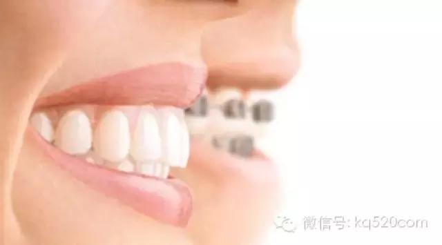 牙套上的丑钢丝,牙套上钢丝有一点锈